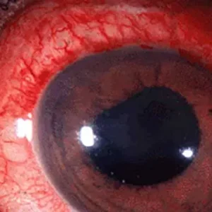 Uveitis Treatment